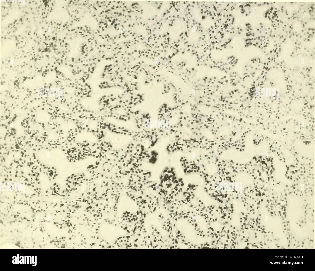 . Il carcinoma della tiroide in salmonoid pesci. Trote; tiroide; cancro gozzo. Boll. U. S. B. F. 1912. Piastra CVIII.. Hi&LT;;. 118.-Sezione vicino alla periferia della tiroide ingrandita del cane 18. Il processo è meno intenso quello vicino al centro- come illustrato in figura 117 e 119. Epitelio colonnare, segnato crescite papillare in alveoli distorto. Colloid assente. XlbU.. Si prega di notare che queste immagini vengono estratte dalla pagina sottoposta a scansione di immagini che possono essere state migliorate digitalmente per la leggibilità - Colorazione e aspetto di queste illustrazioni potrebbero non perfettamente assomigliano al lavoro originale. Foto Stock