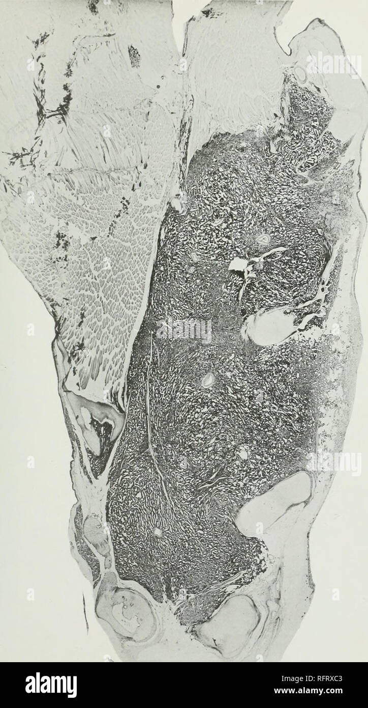 . Il carcinoma della tiroide in salmonoid pesci. Il cancro; il gozzo; tiroide; trota. Boll. U. S. B. F. 1912. Piastra XCIV. Fig. 90.-^ bassa sezione di alimentazione alla linea mediana attraverso la regione della tiroide di wild Wisconsin trota di fiume, .che mostra ben sviluppato il carcinoma della tiroide infiltranti strutture circostanti, osso e cartilagine. Dopo diciotto mesi di fegato crudo alimentare a Craig Brook. Induzione sperimentale di carcinoma della thvroid. X13.. Si prega di notare che queste immagini vengono estratte dalla pagina sottoposta a scansione di immagini che possono essere state migliorate digitalmente per la leggibilità - Colorazione e aspetto di questi ho Foto Stock