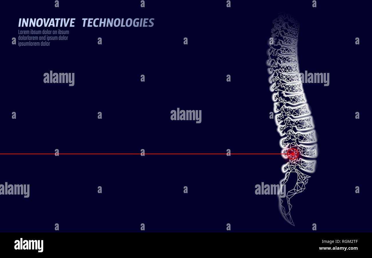 Fisioterapia Laser colonna vertebrale umana pregiudizio. Area di dolore operazione di chirurgia moderna medicina di lombo di bassa tecnologia poli triangoli 3D render femmina ernia indietro Illustrazione Vettoriale