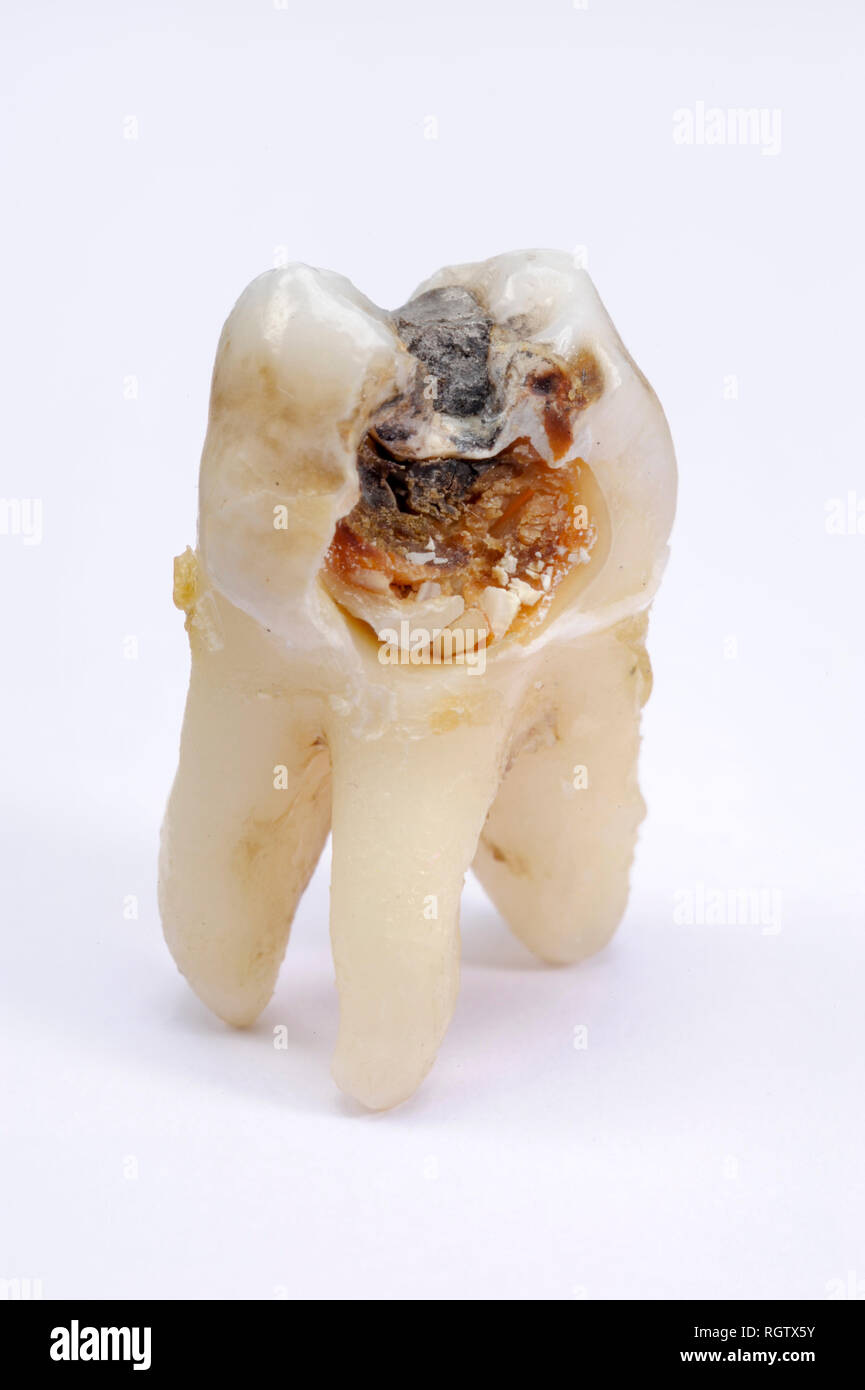 Estratto il dente molare con la carie e amalgama Foto Stock