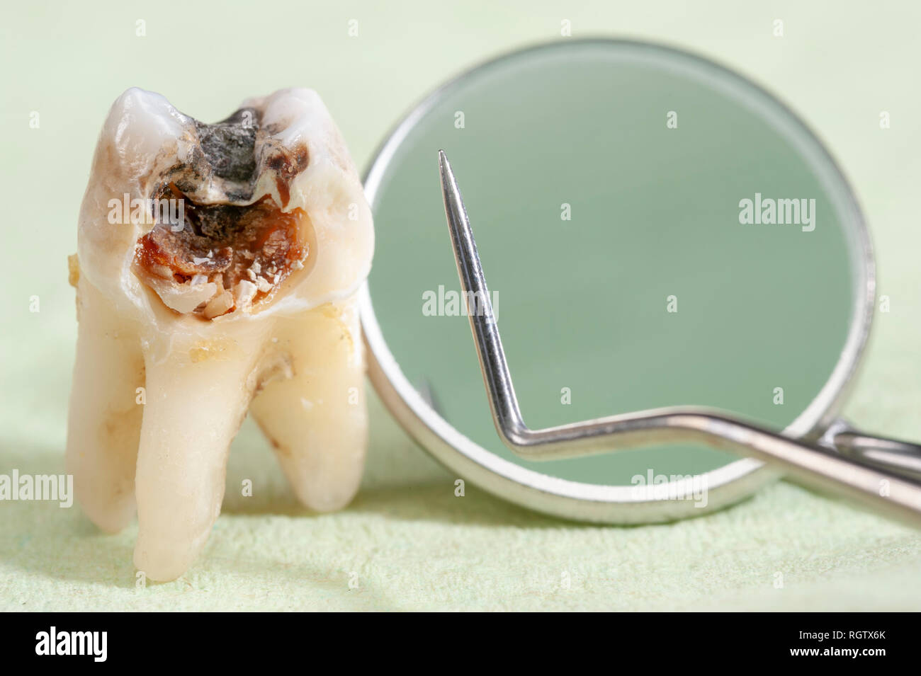Estratto il dente molare con la carie e amalgama Foto Stock