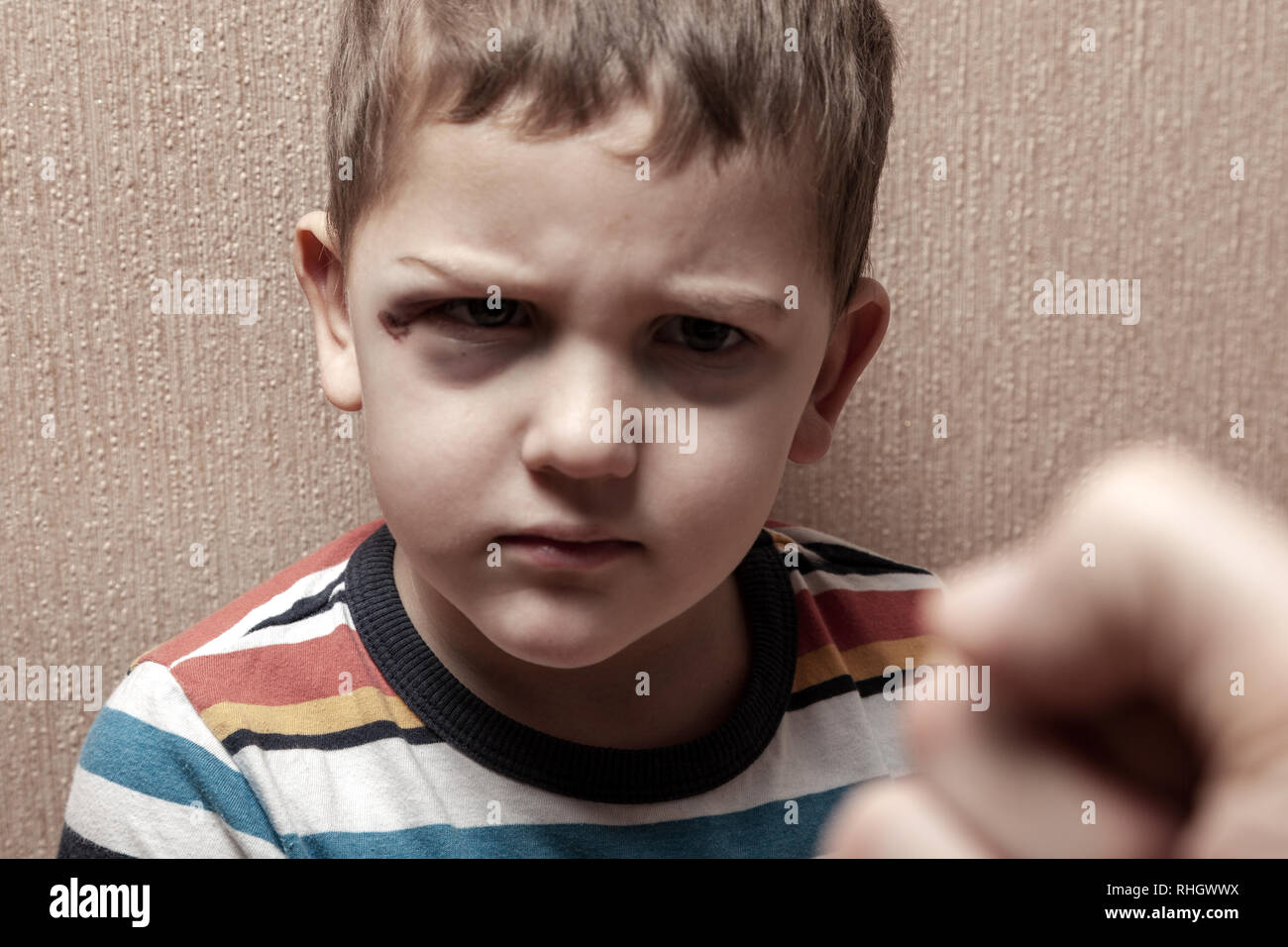 Boy Bruises Immagini e Fotos Stock - Alamy