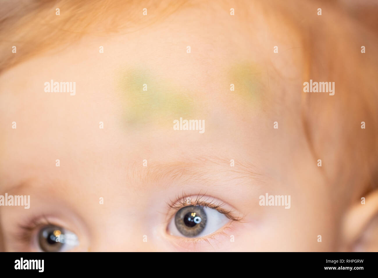 Livido sul fronte di un giovane bambino caucasico Foto Stock