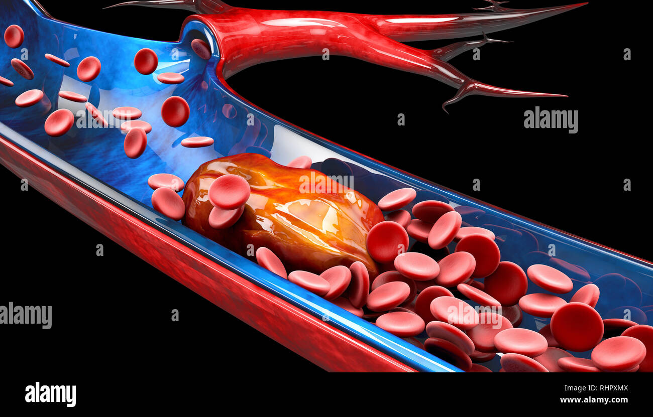 3d illustrazione di trombosi venosa profonda o coaguli di sangue. L'embolia Foto Stock