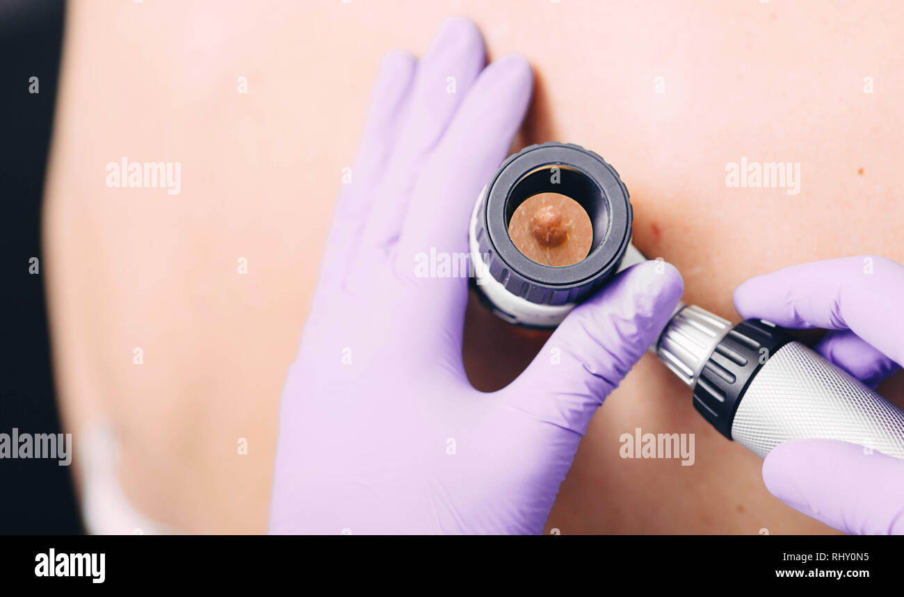 Il dermatologo esaminando mole sul retro femmina utilizzando dermatoscope Foto Stock