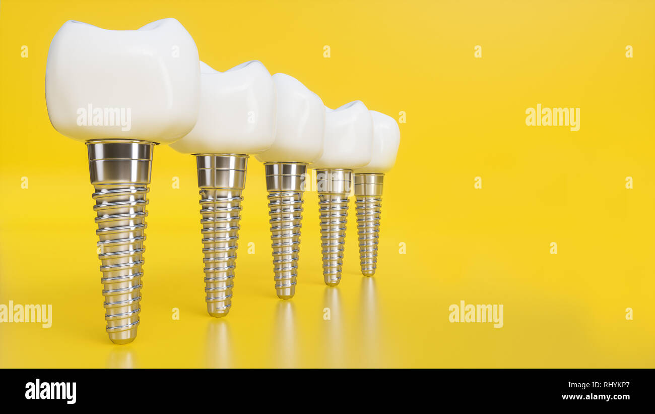 Dente impianto umano. Denti umani o protesi su sfondo giallo -- 3d rendering Foto Stock