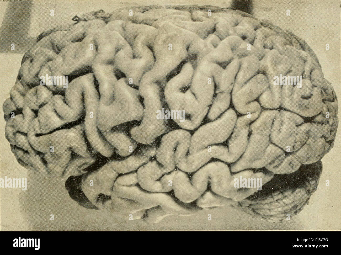 . Ciba Foundation colloqui sull'invecchiamento. Vecchiaia e invecchiamento; Animali -- la crescita &AMP; sviluppo. Fig. 1. Presenile generalizzato di atrofia del hrain (morbo di Alzheimer. ' •- " Un " ""**. % :. Fig. 2. Placche senili e grovigli degenerazione nella malattia di Alzheimer. [Pagina a fronte 134. Si prega di notare che queste immagini vengono estratte dalla pagina sottoposta a scansione di immagini che possono essere state migliorate digitalmente per la leggibilità - Colorazione e aspetto di queste illustrazioni potrebbero non perfettamente assomigliano al lavoro originale. Ciba Foundation; Wolstenholme, G. E. W. (Gordon Ethelbert Ward). Boston, poco, marrone Foto Stock