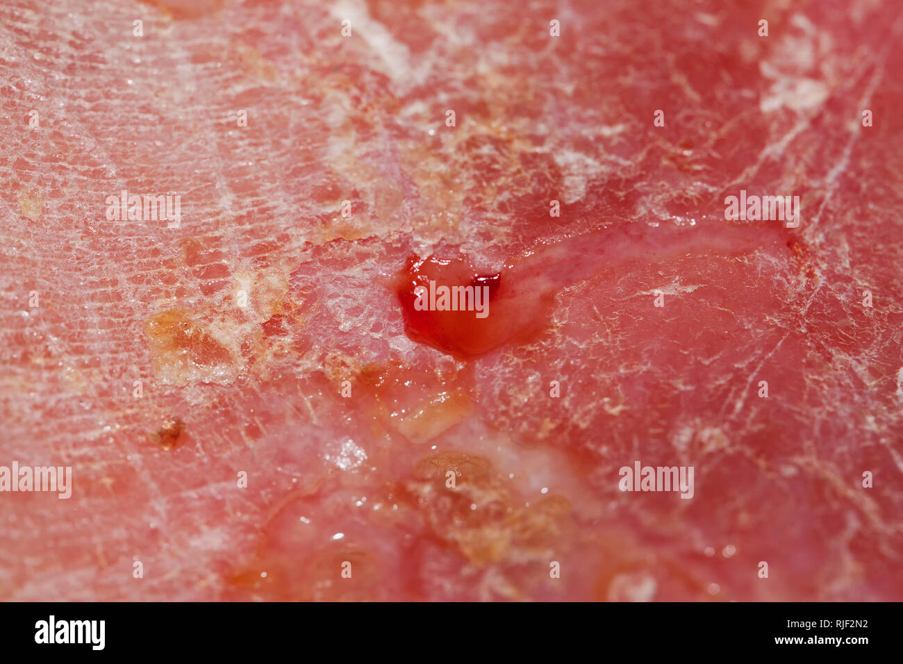 Neurodermatite acuta rispettivamente eczema atopico Foto Stock