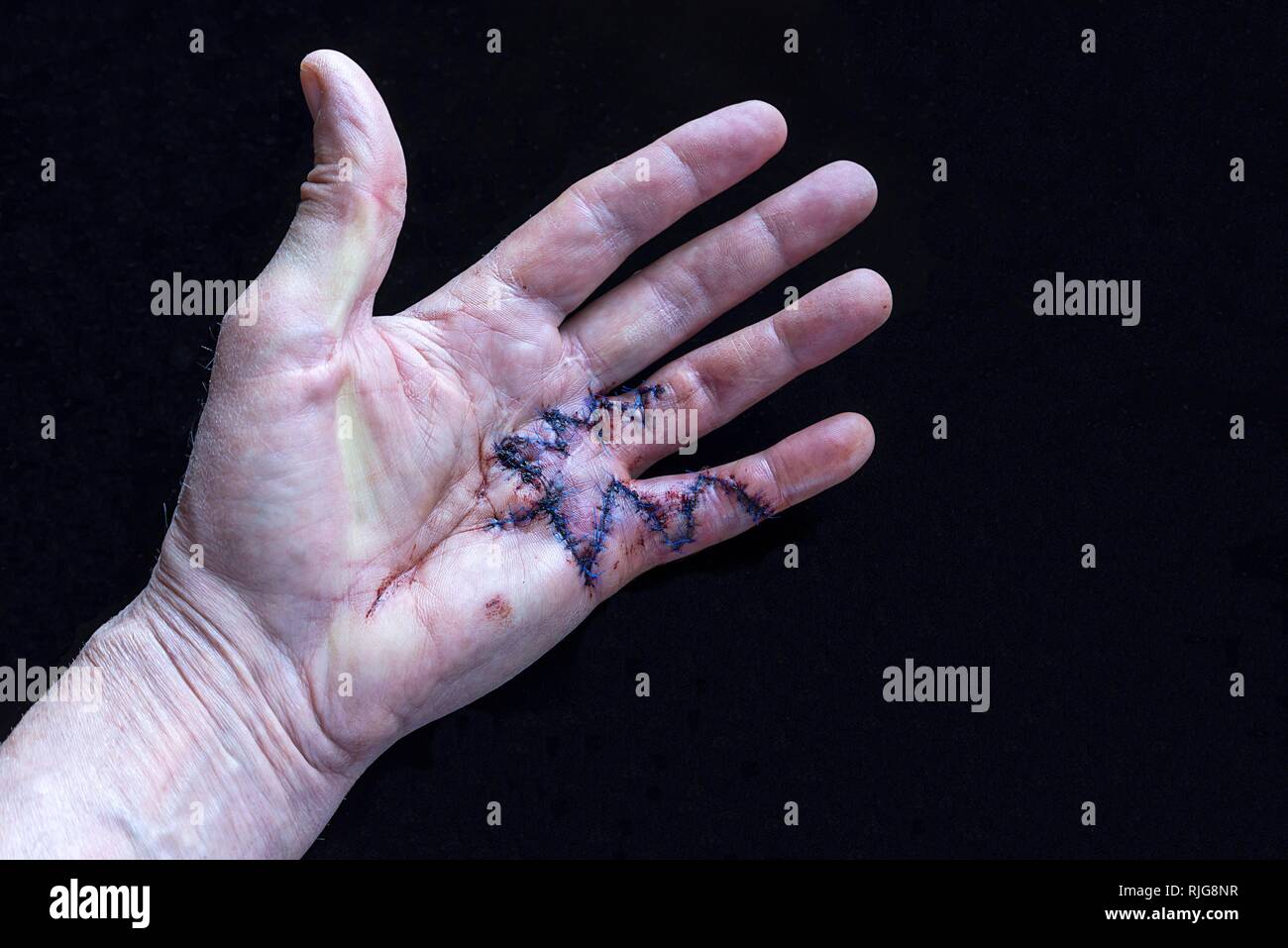 Fresco di suture chirurgiche di un Duypuytren contrattura della sulla piccola e l'anello dito della mano sinistra, Germania Foto Stock