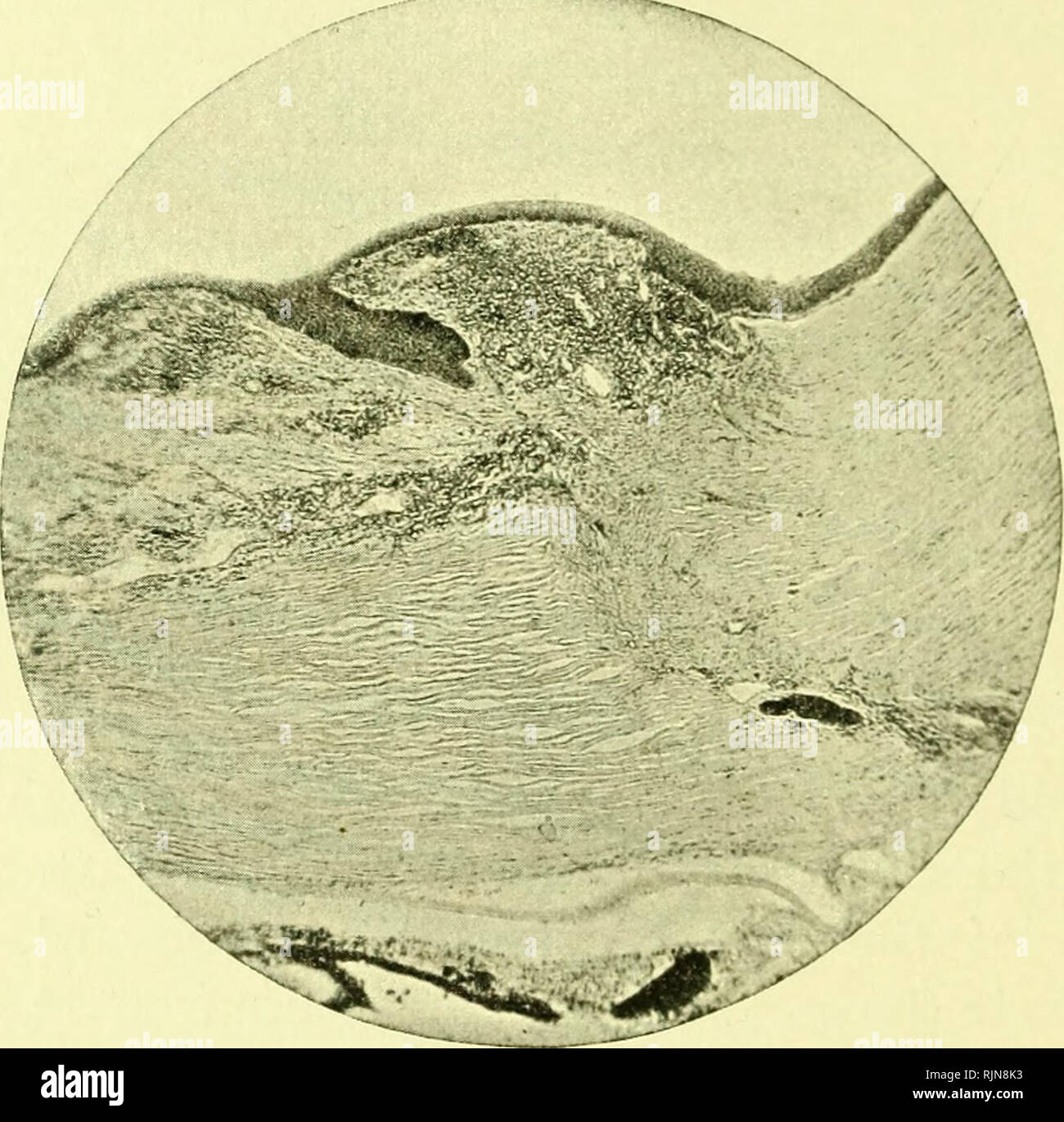 . La patologia e batteriologia [risorsa elettronica]. Oftalmologia; occhio; occhio; batteriologia; oftalmologia; occhio; batteriologia; occhio. 38o lesioni ferite della congiuntiva.-^ferite superficiali del bulbo oculare dietro il limbus, coinvolgendo la congiuntiva e strati anteriore della sclerotica, sono spesso seguiti da molto emorragia subcongiuntivale. Il sangue effuso sarà facilmente permeato allentato il tessuto sottocongiuntivale e si estendono fino al fissaggio della congiuntiva al margine della cornea. A volte il pigmento di sangue si diffondono da una emorragia subcongiuntivale nella sostanza della cornea, macchia Foto Stock