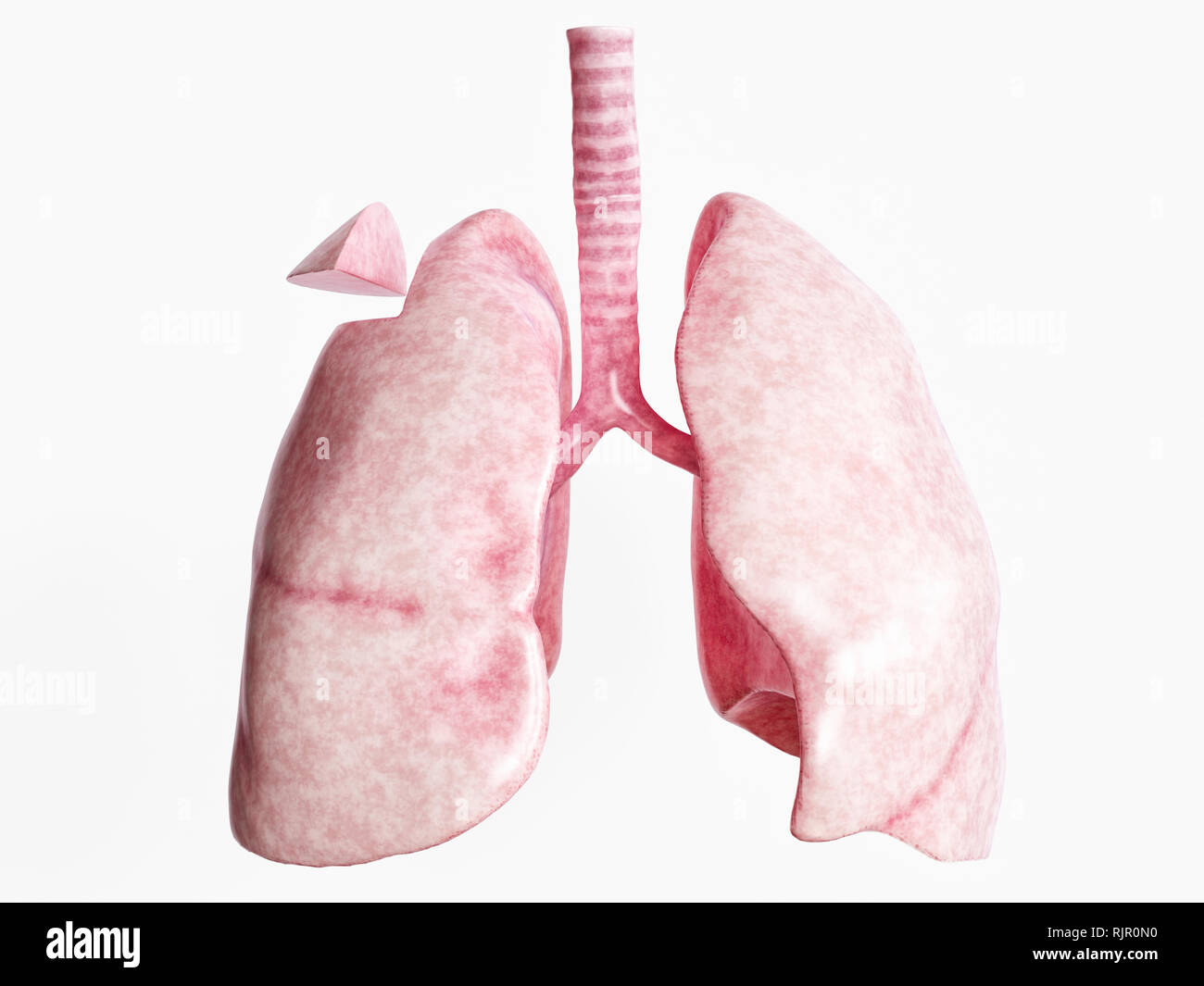 La resezione a Cuneo dopo una grave malattia polmonare - 1 di 4 - 3D Rendering Foto Stock