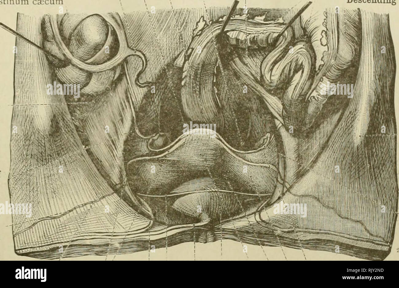 . Un atlante di anatomia umana per gli studenti e per i medici. Anatomia. Anatomia Topografica delle viscere pelvico 537 retto Intestinum retto sacca di Douglas, o sacca rectovaginal Excavatio recto uterina (cavum Douglasi) Vermiform appendice i roceisub ermitormis cieco-Intebtini Uterosacral legamento o piega di Douglas' Plica recto-uterina (Uouglasi) sigmoide mesocolon 1 Mesocolon sinmoideum flessura sigmoidea del colon 1 Colon sir,nioideum colon discendente-Colon descendens Subcecal fossa Fossa cx'calib legamento sospensivo dell'ovaio (infundibu o pelvico ovariopelvic o piegare o legamento Lig. Foto Stock
