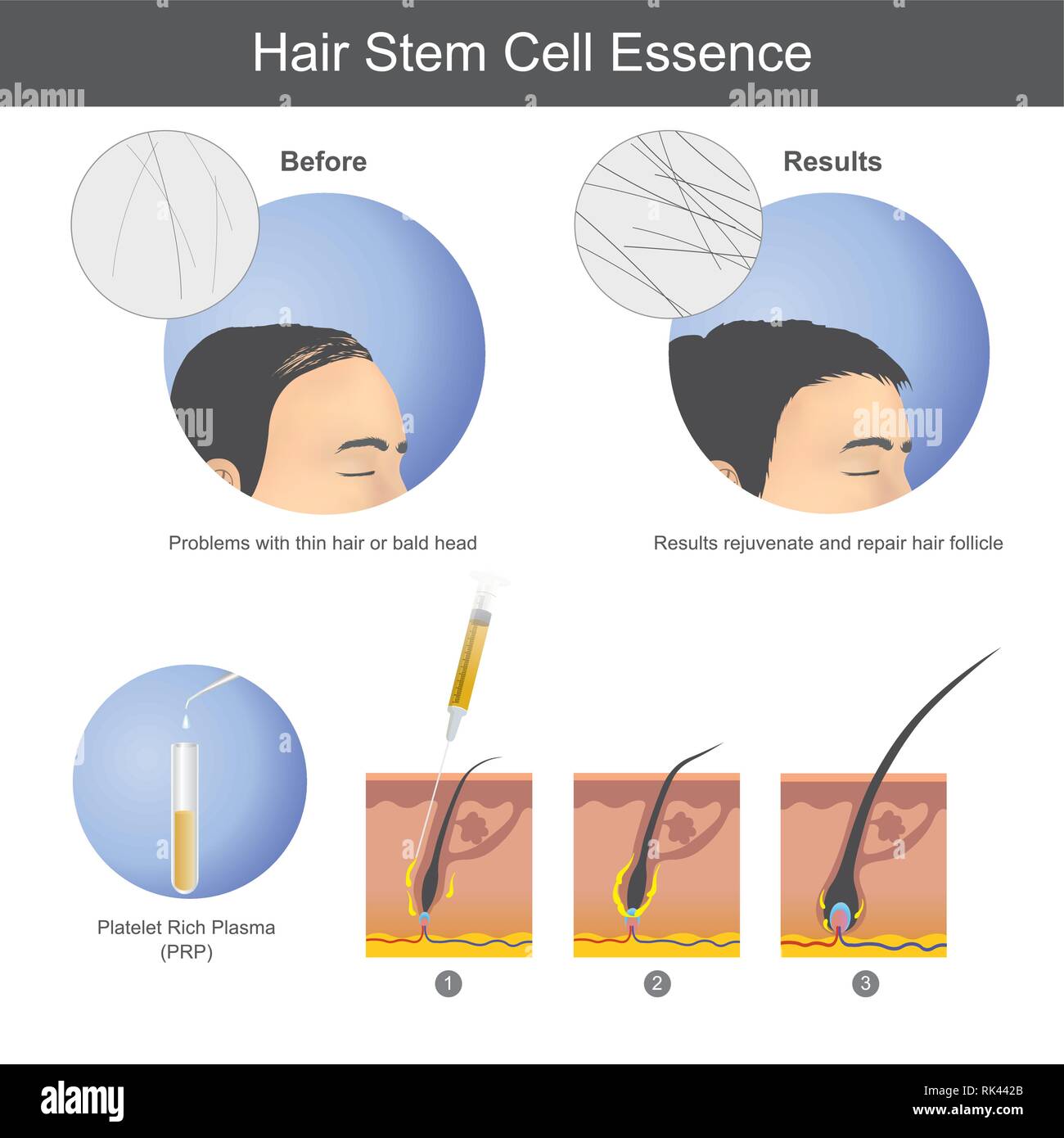 Stimolare la crescita dei capelli utilizzando il plasma ricco di piastrine (PRP) per iniettare sul cuoio capelluto fino a che penetra fino alla radice dei capelli. Infografico della cura della salute. Illustrazione Vettoriale