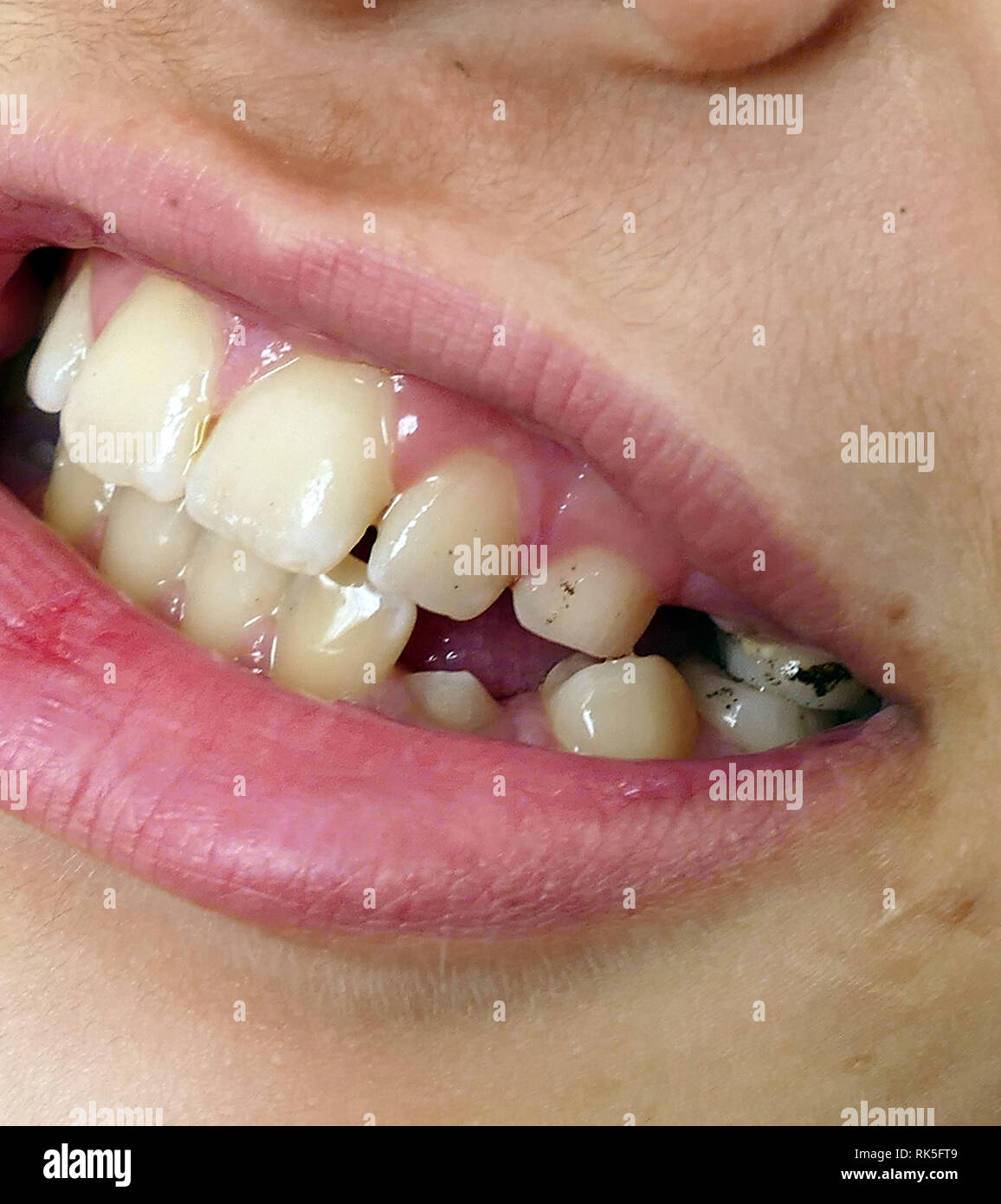 Orale e salute dentale, tartaro e macchie nere sui denti Foto stock - Alamy