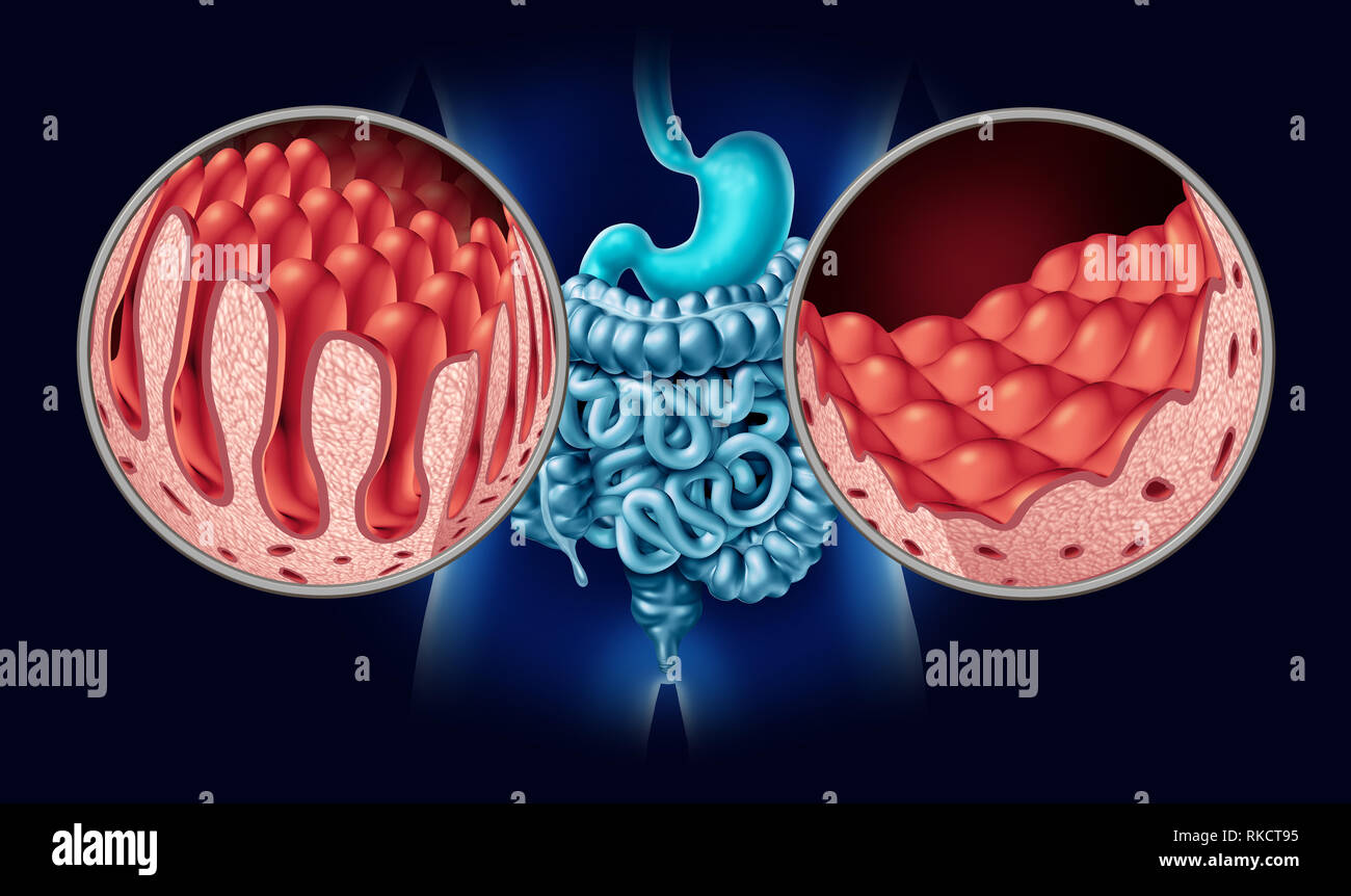 Celiachia o malattia celiaca come un intestino anatomia concetto medico con normale villi e danneggiato intestino piccolo rivestimento come un disturbo autoimmune. Foto Stock