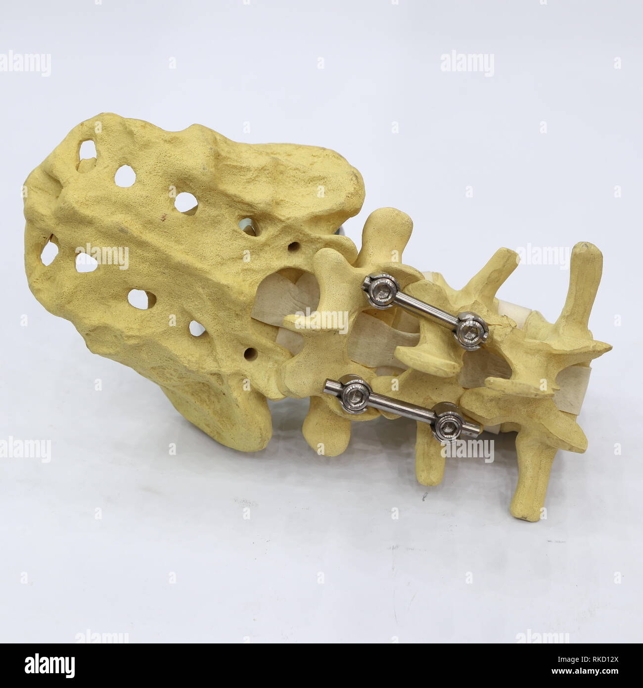 Fissazione spinale sistema - staffa di titanio ; close up Foto Stock