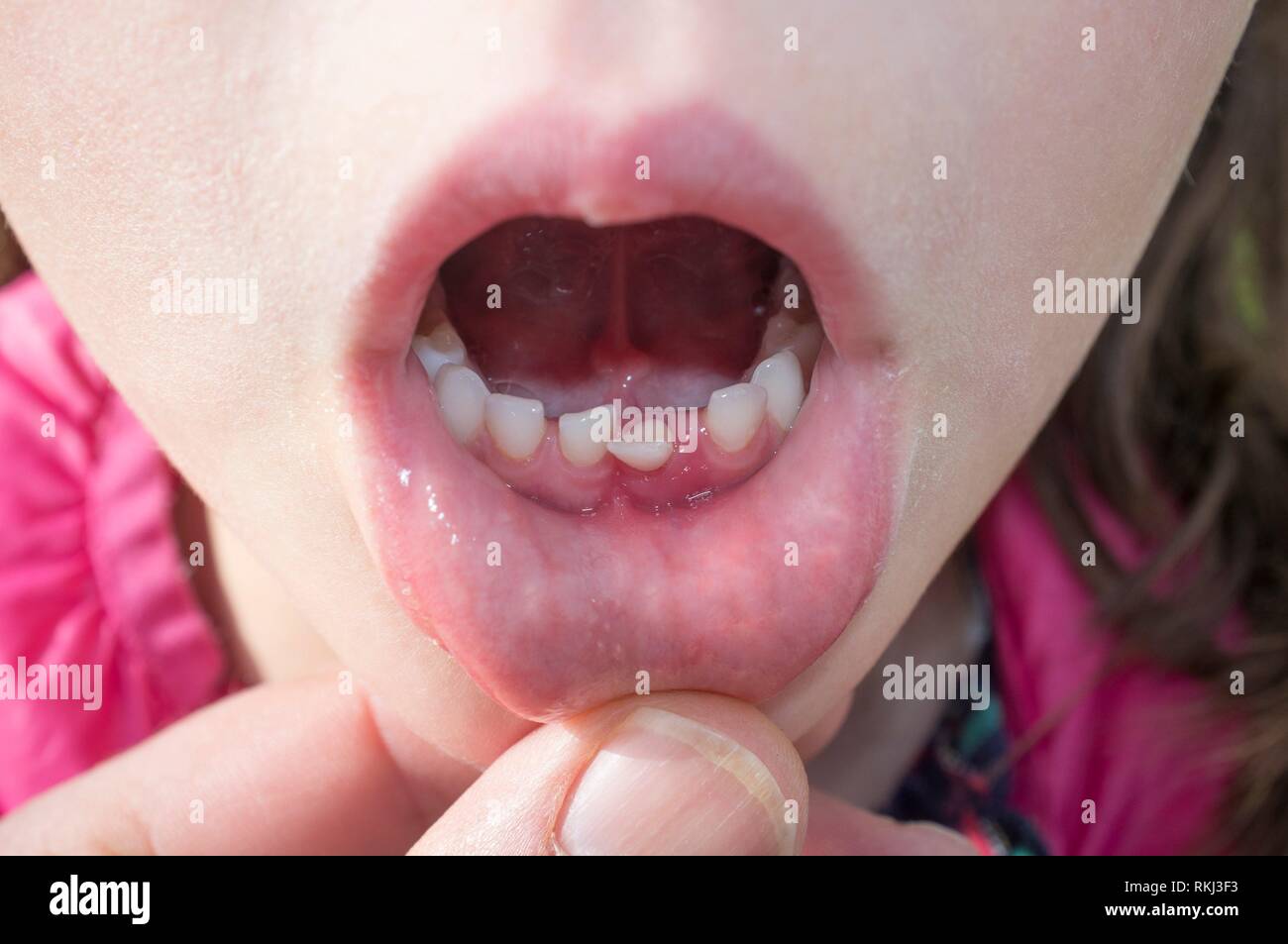 Poco più di 5 anni ragazza mostrando il suo primo dente allentato. Primo piano. Foto Stock