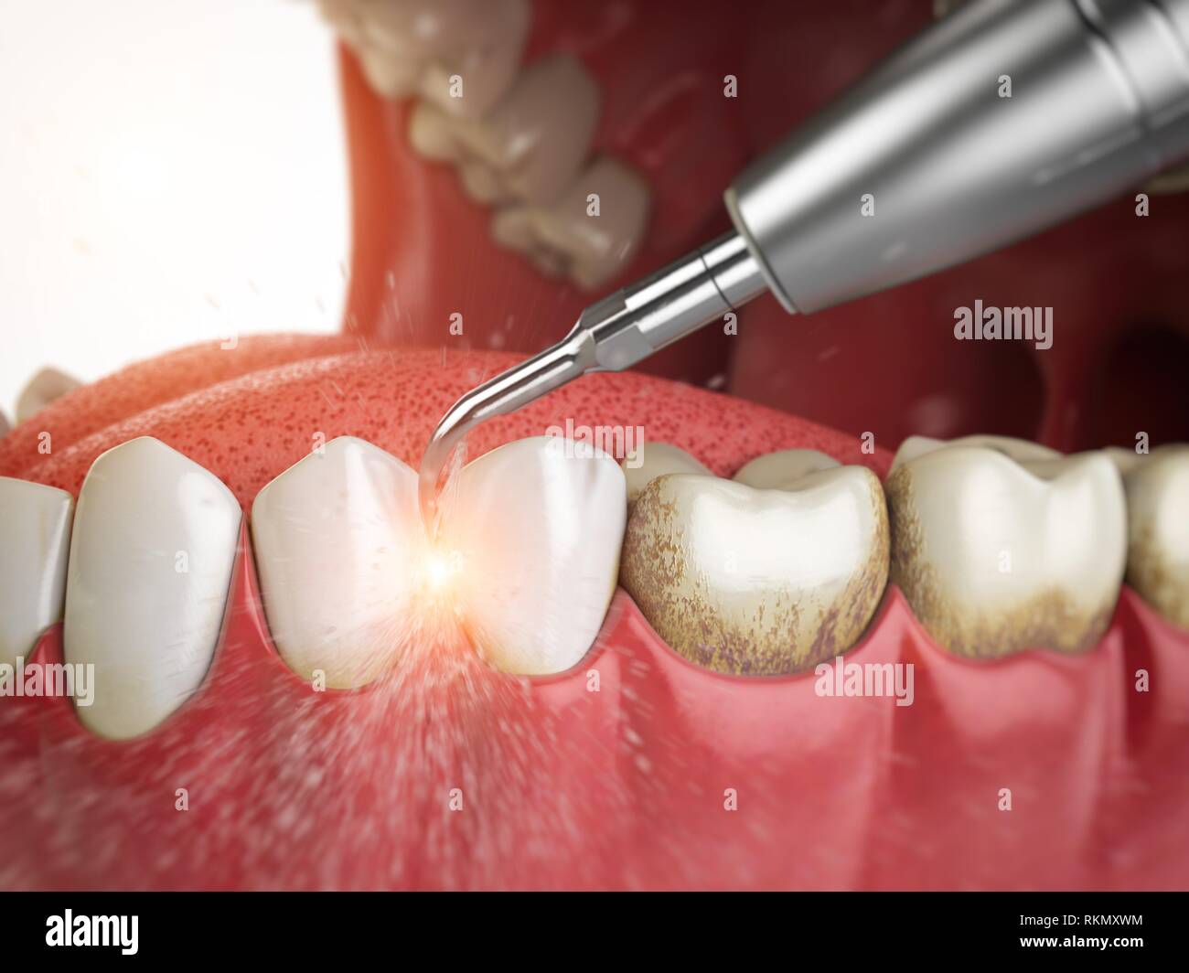 Pulizia dei denti professionale. Denti ad ultrasuoni pulizia della macchina  elimina il tartaro dentale da denti umani. 3d'illustrazione Foto stock -  Alamy