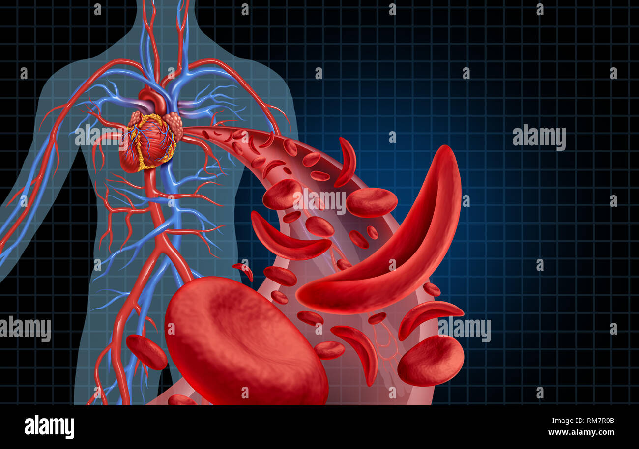 La falce cella cuore cardiovascolare la circolazione del sangue e anemia come una malattia con normale e di emoglobina anormale in una arteria umana anatomia. Foto Stock