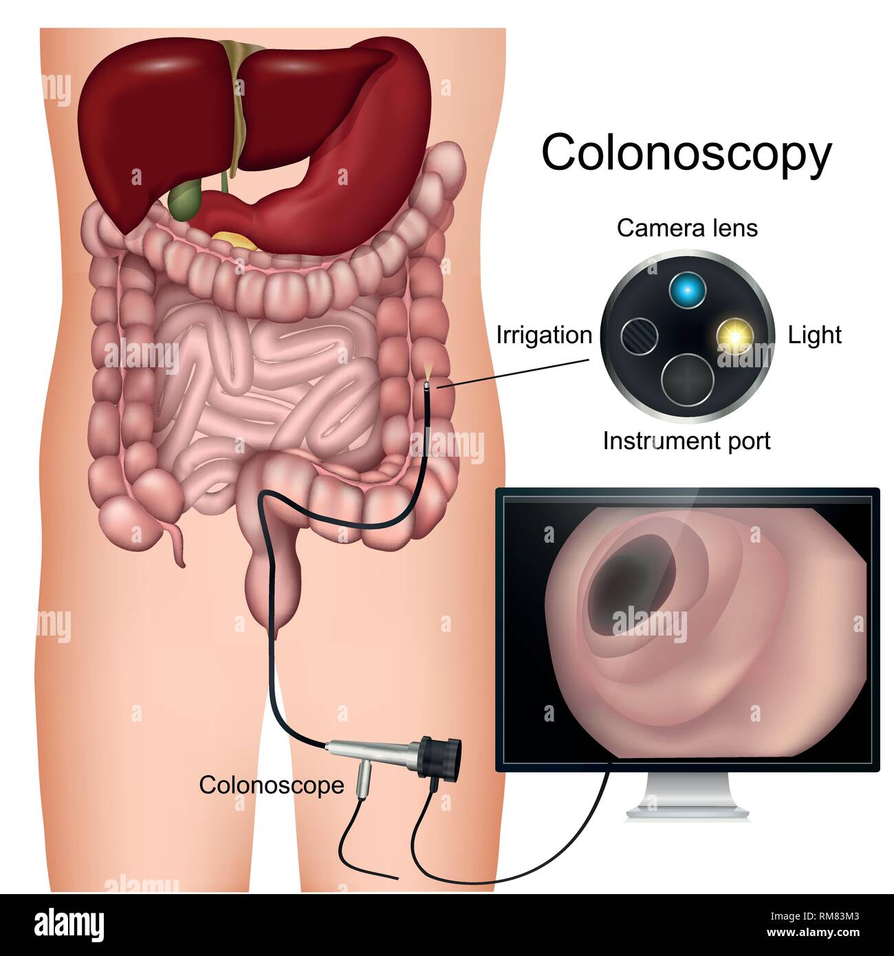 Colonoscopia procedura denominata 3d diagramma vettoriale su sfondo bianco Illustrazione Vettoriale