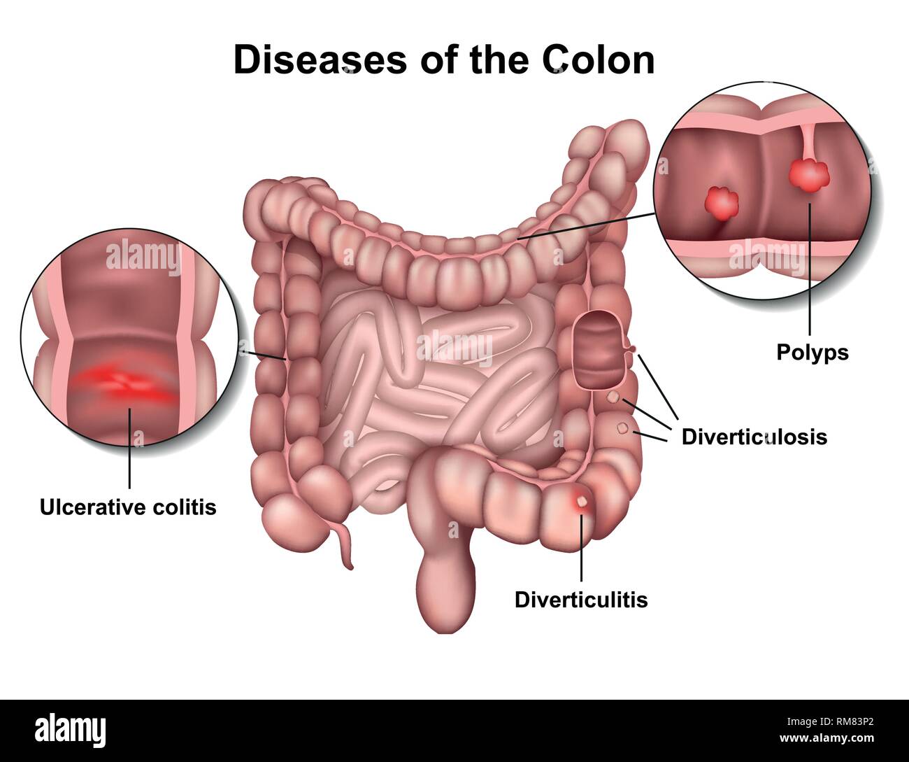 Malattie del colon 3d medical illustrazione vettoriale su sfondo bianco Illustrazione Vettoriale