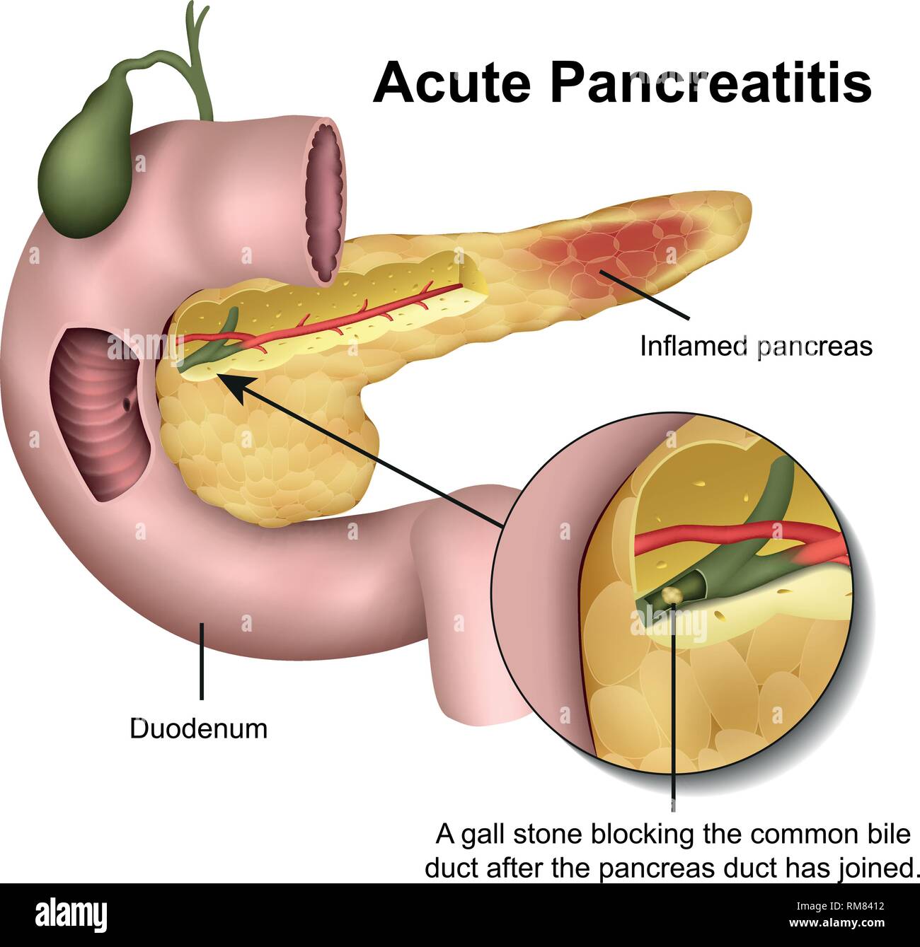 La pancreatite acuta 3d medical illustrazione vettoriale su sfondo bianco Illustrazione Vettoriale