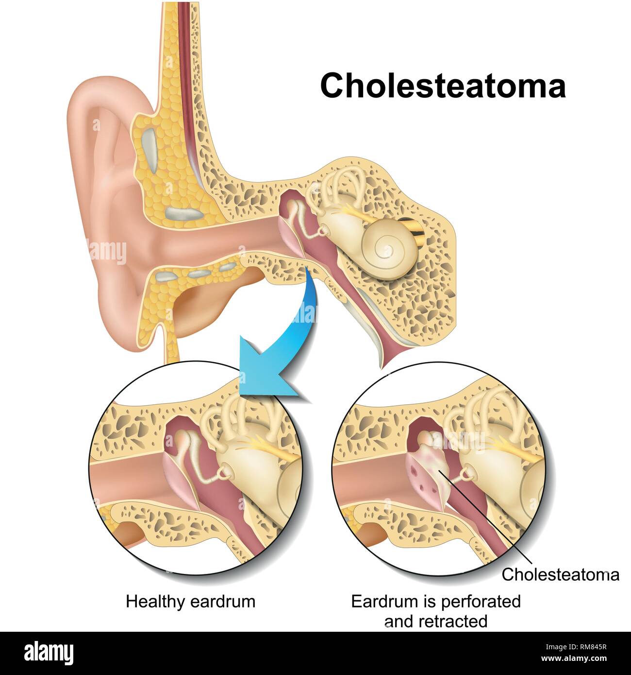 Colesteatoma orecchio umano anatomia illustrazione vettoriale su sfondo bianco Illustrazione Vettoriale