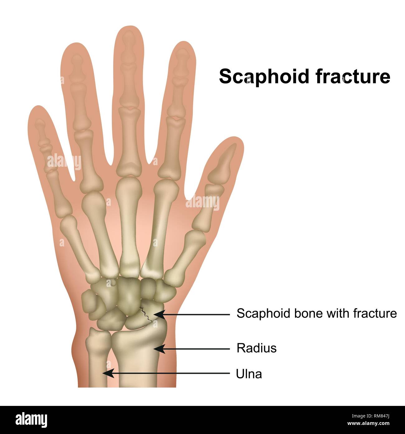 Scafoide frattura ossea medical illustrazione vettoriale su sfondo bianco Illustrazione Vettoriale