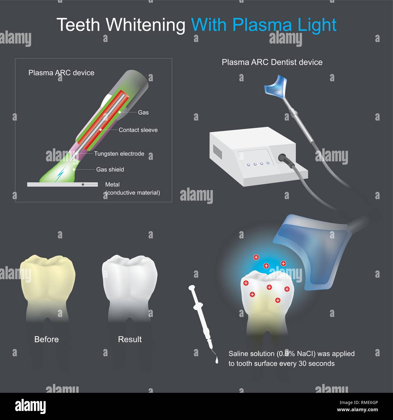 Fa sì che le macchie di colore sulla superficie del dente a scomparire per via chimica ed i metodi elettrici Illustrazione Vettoriale