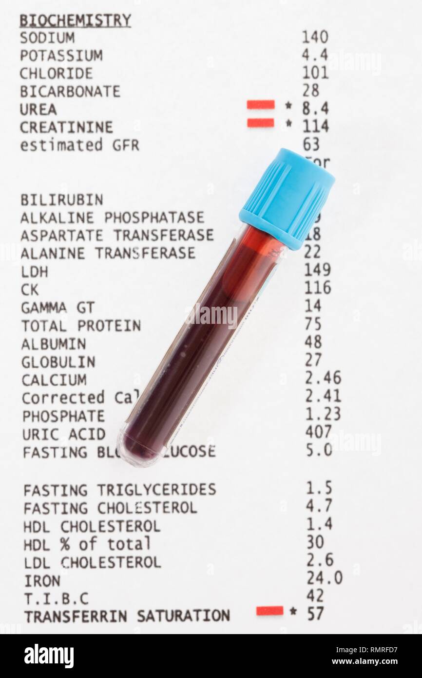 Il sangue i risultati dei test con il campione di sangue. Foto Stock