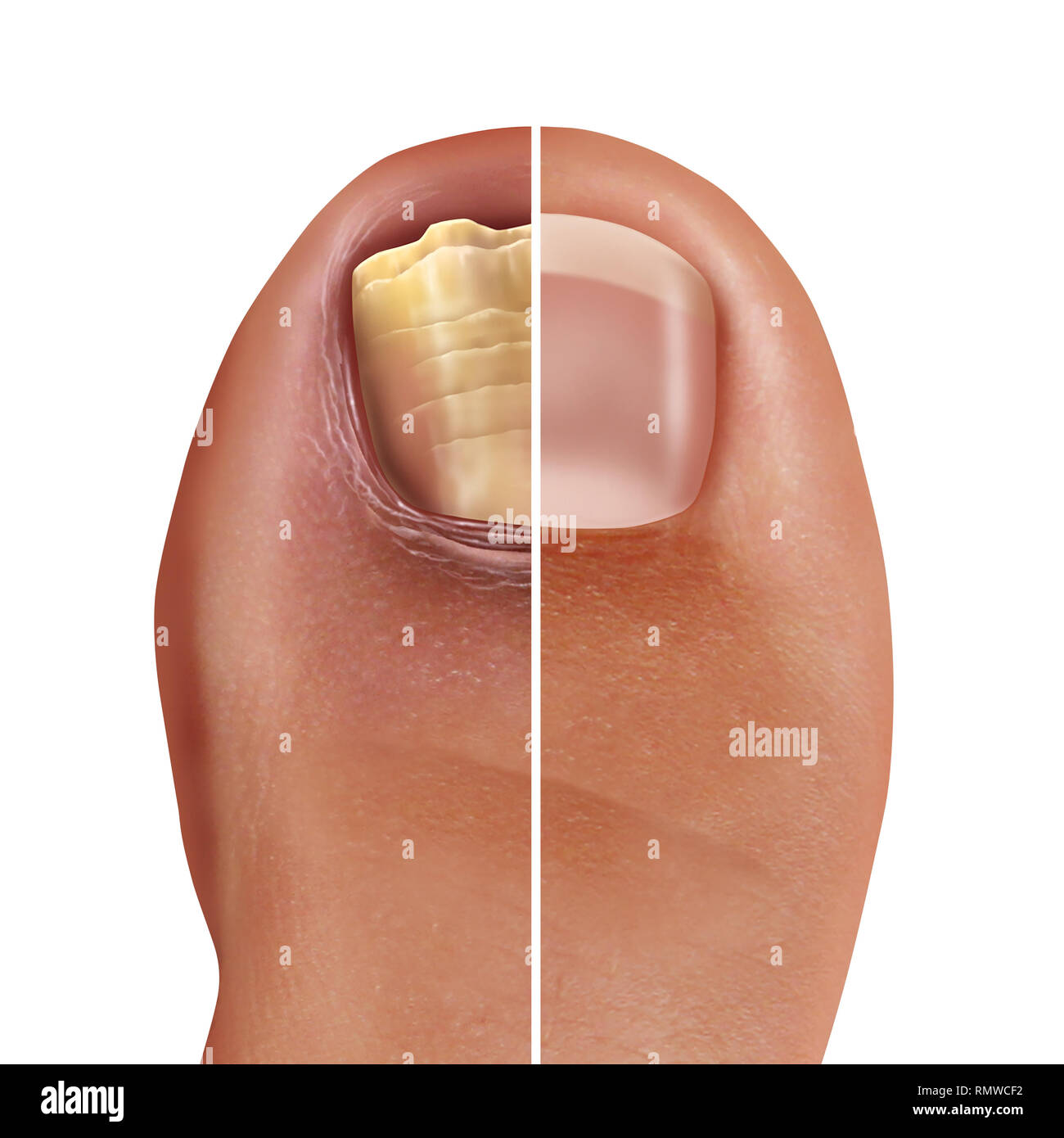Infezioni fungine delle unghie e infezione onychomycosisor tinea unguium come un piede infetto toenail o punta chiodo con danni malsano e sano di anatomia umana. Foto Stock
