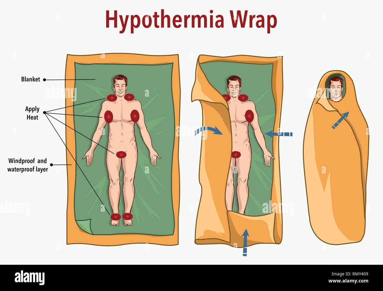 Illustrazione vettoriale di una ipotermia wrap e primo soccorso Illustrazione Vettoriale