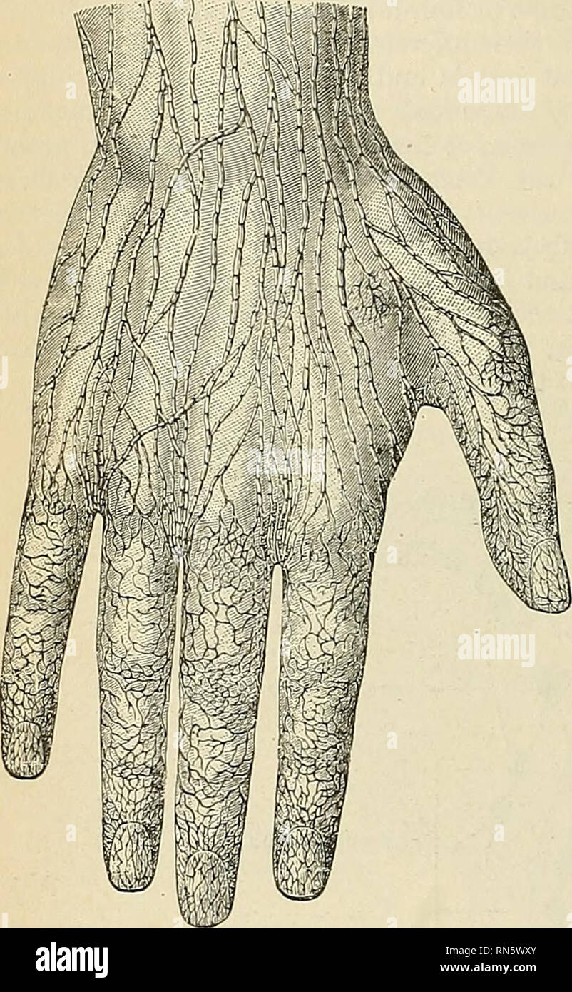 . Anatomia, descrittivo e applicata. Anatomia. 784 I SISTEMI VASCOLARI nodi. Nell'avambraccio ci sono circa trenta navi, al centro del braccio vi sono da quindici a diciotto (Sappey). La profonda di vasi linfatici della estremità superiore di convogliare la linfa dalle ossa del periostio, muscoli, legamenti, ecc. Essi passano l'arto con il chief navi, è usualmente di due tronchi di ciascuna arteria. Nel braccio ci sono due o tre navi. Alcune poche navi terminano nei nodi piccoli lungo la radiale, ulnare, e brach- ial arterie, ma la maggior parte di essi passano direttamente ai nodi ascellari. Applicato Foto Stock