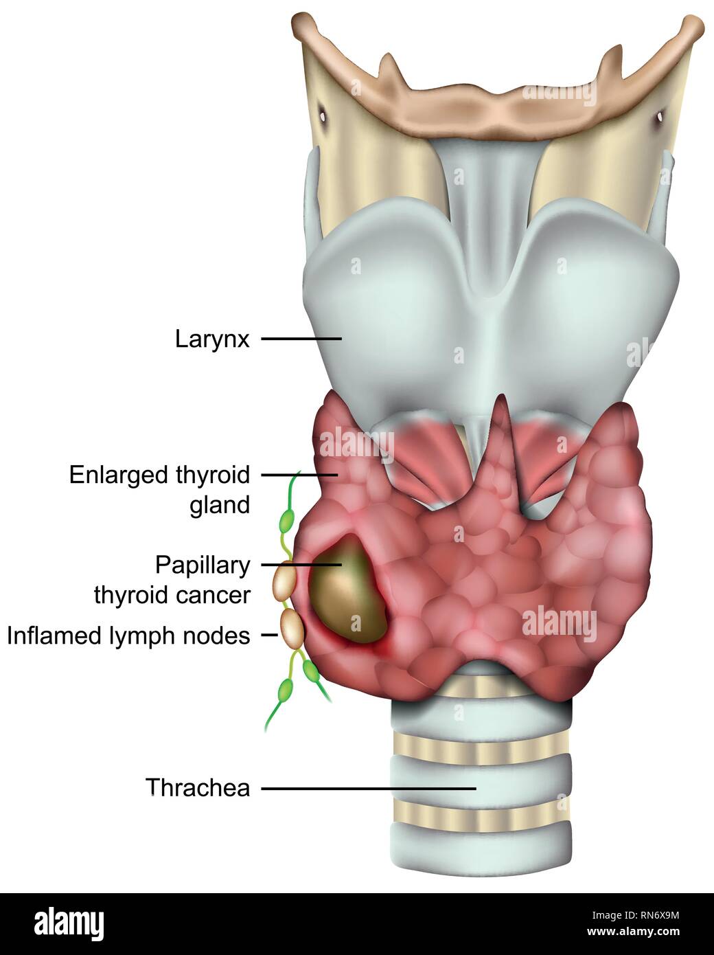 Il cancro della tiroide 3d medical illustrazione vettoriale su bianco backround Illustrazione Vettoriale