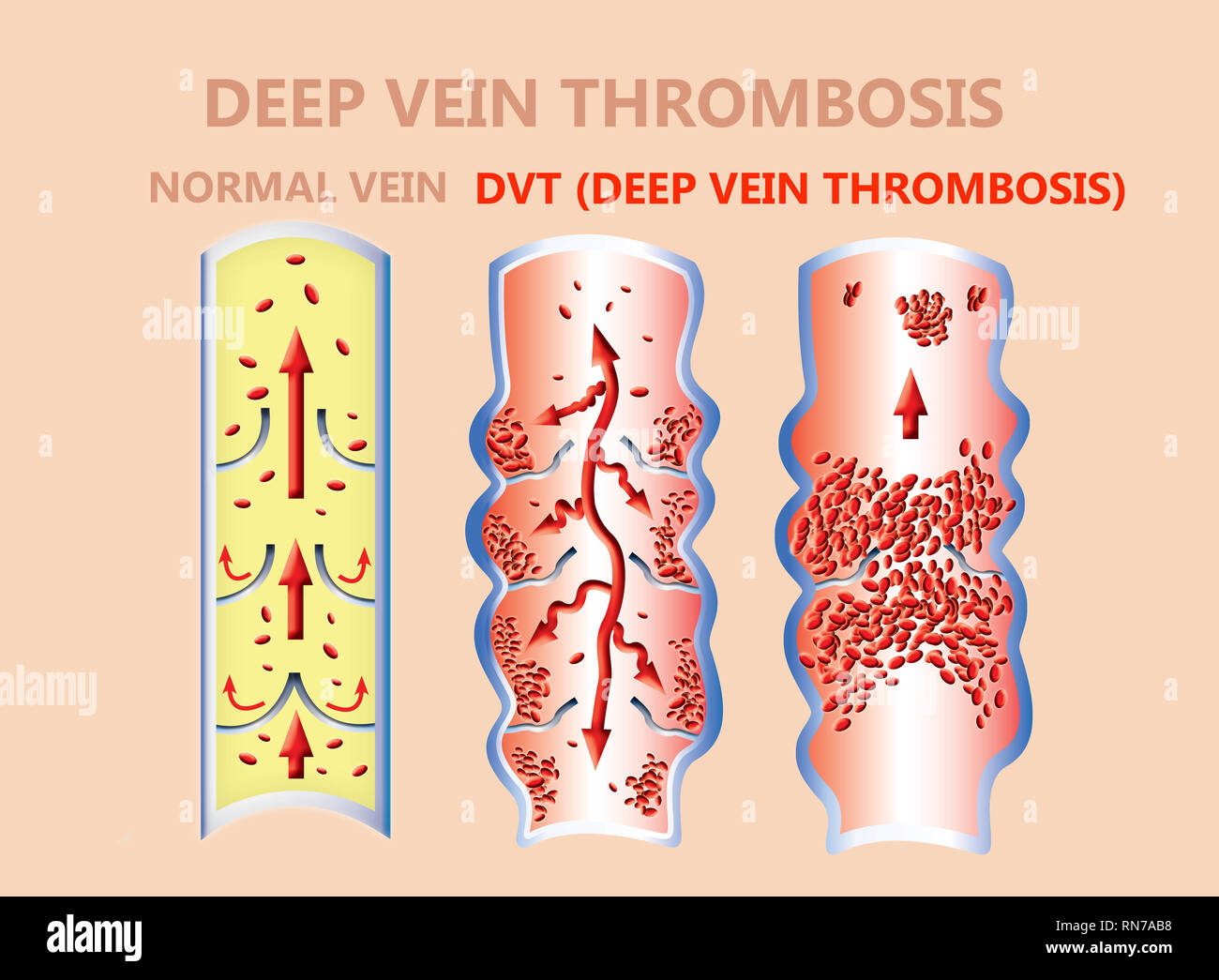 La trombosi. Dal normale flusso di sangue a formazione di coaguli sanguigni Foto Stock