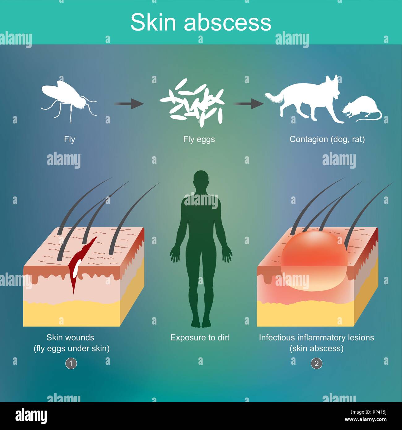Infiammazione della pelle derivanti da agenti patogeni di entrare aprire le ferite della pelle. Illustrazione Vettoriale