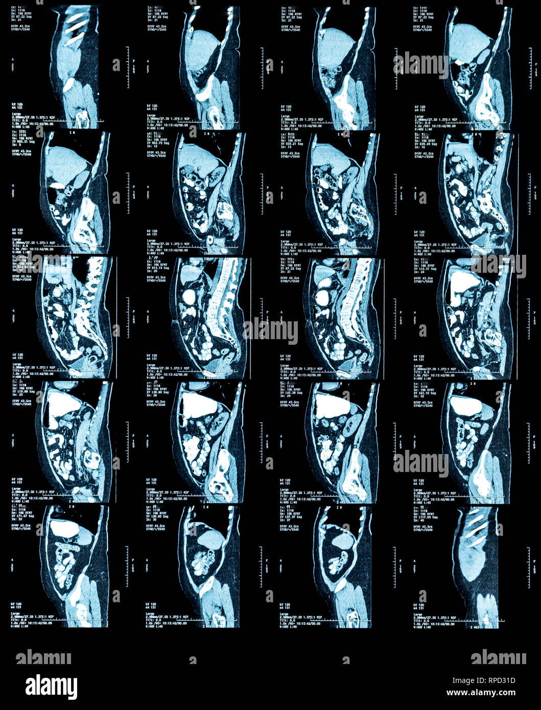 Immagini a risonanza magnetica (MRI) di torace e addome Foto Stock