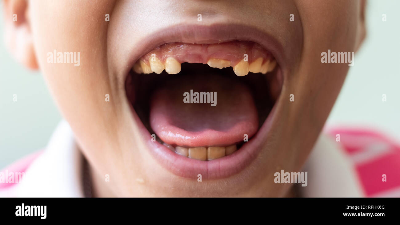 Little Boy mostrano i denti rotti.ragazzo con una rotta e denti cariati Foto Stock