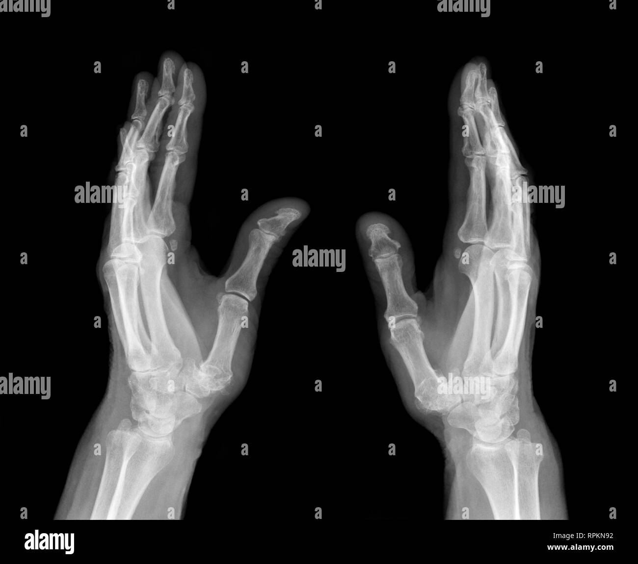 X-ray immagine medica - umani palms Foto Stock