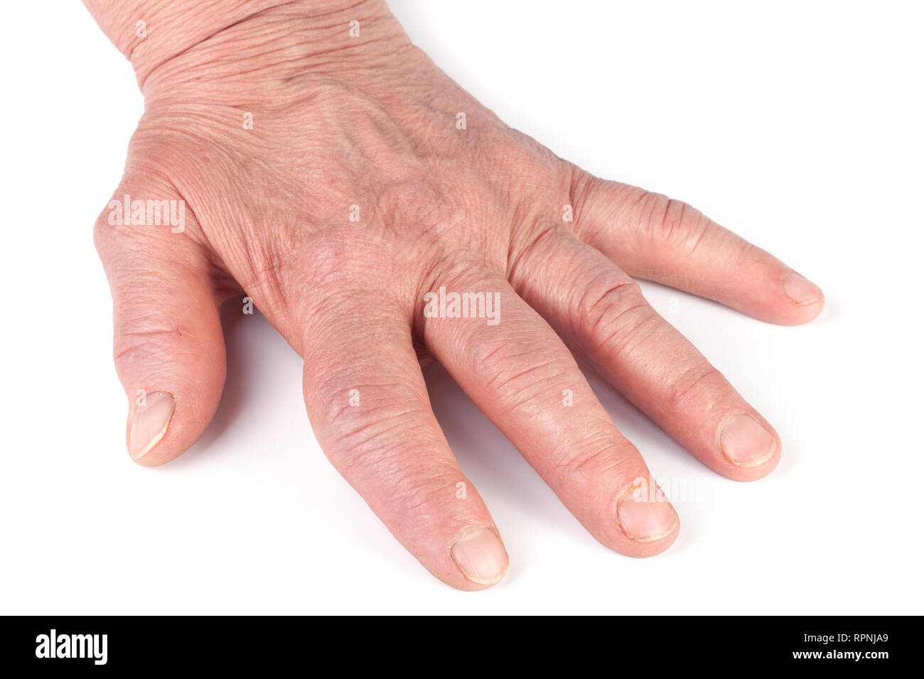 Poliartrite reumatoide delle mani isolati su sfondo bianco Foto Stock