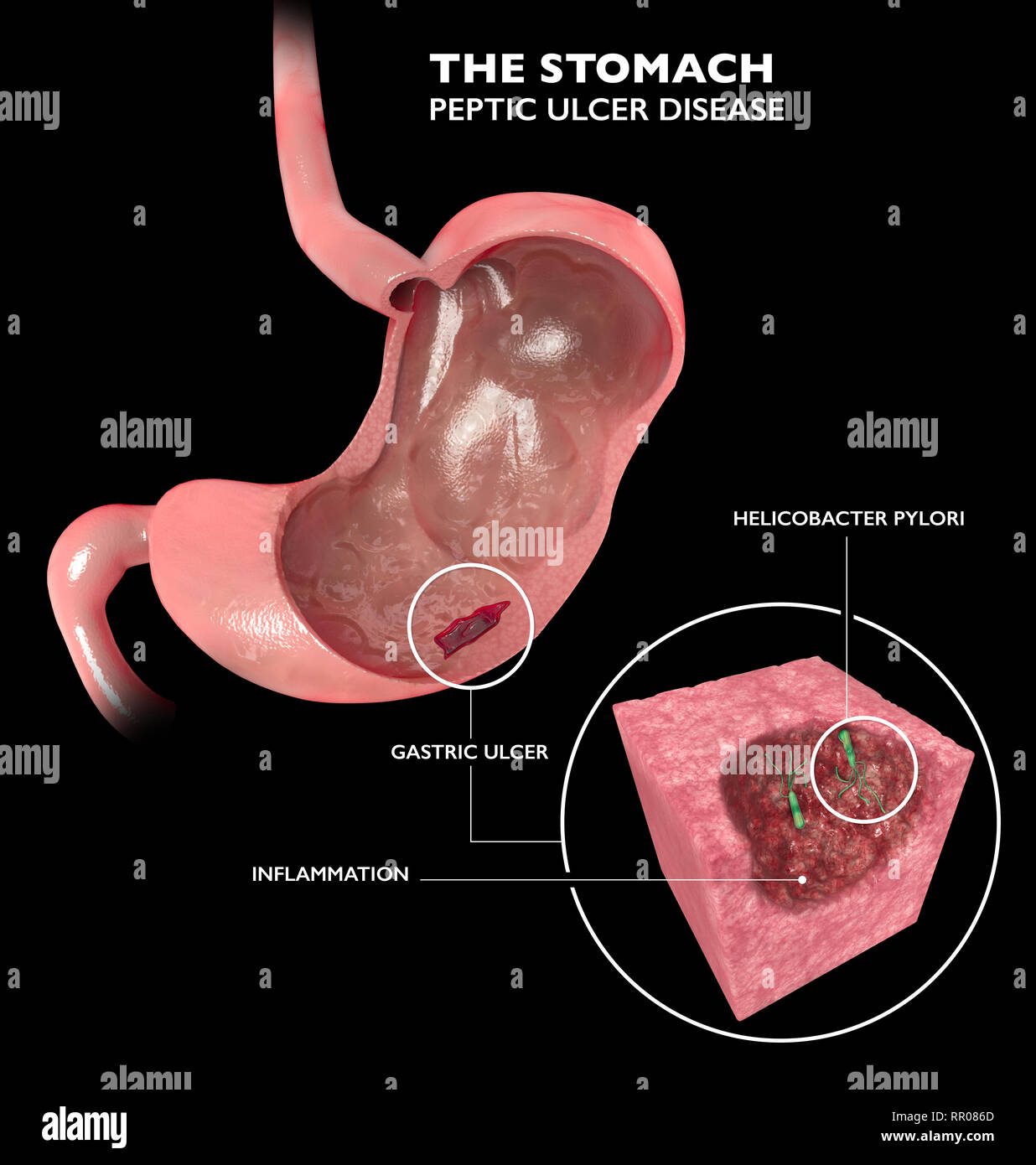 Sezione 3d dello stomaco. Ulcera peptica, ulcera gastrica è una rottura nella fodera interna dello stomaco. Helicobacter pylori Foto Stock