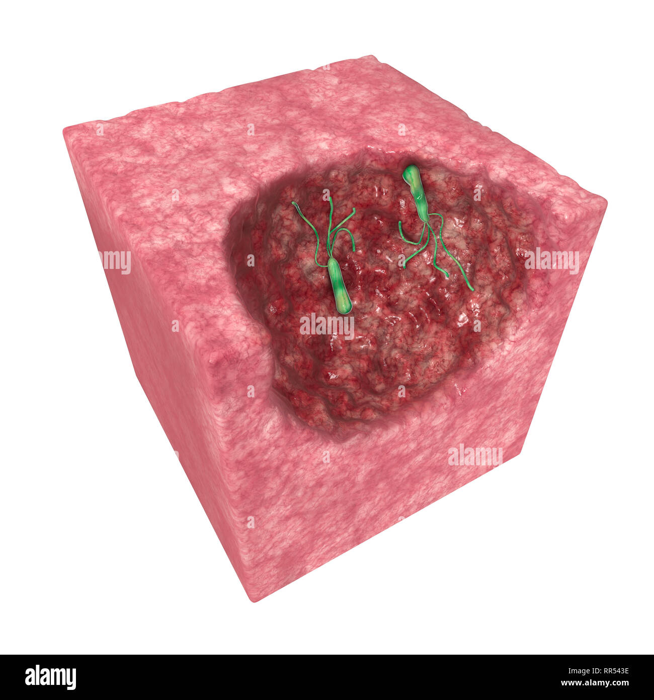 Helicobacter pylori è un batterio microaerofili che di solito si trovano nello stomaco. Esso è presente in una persona con gastrite cronica e ulcere gastriche. Foto Stock