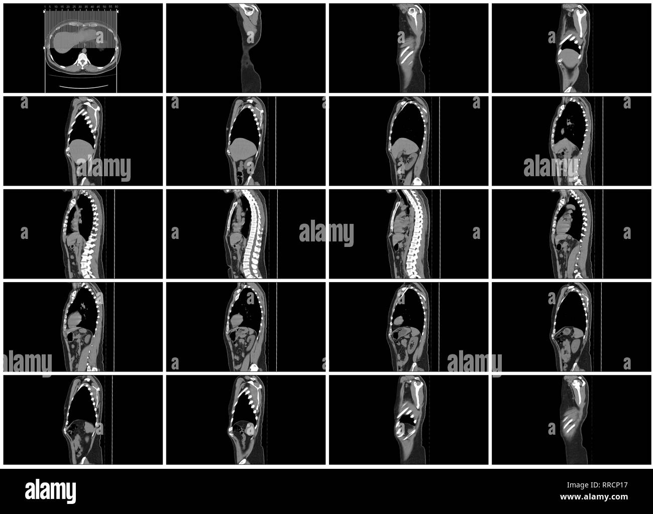 Scansione TC passo impostato del corpo vista sagittale Foto Stock