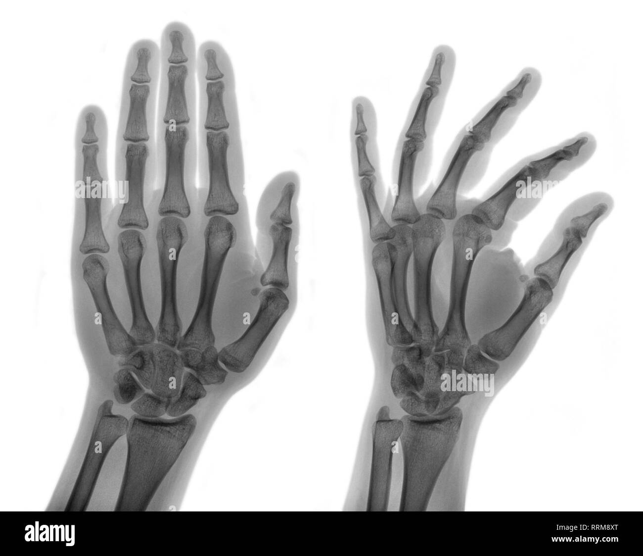 X-ray immagine medica - umani palms, isolato Foto Stock