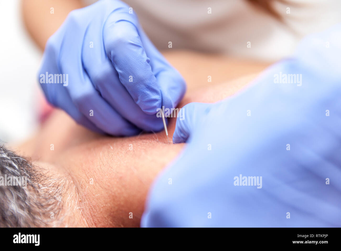 Fisioterapista il trattamento di un paziente con agugliatura secco Foto Stock