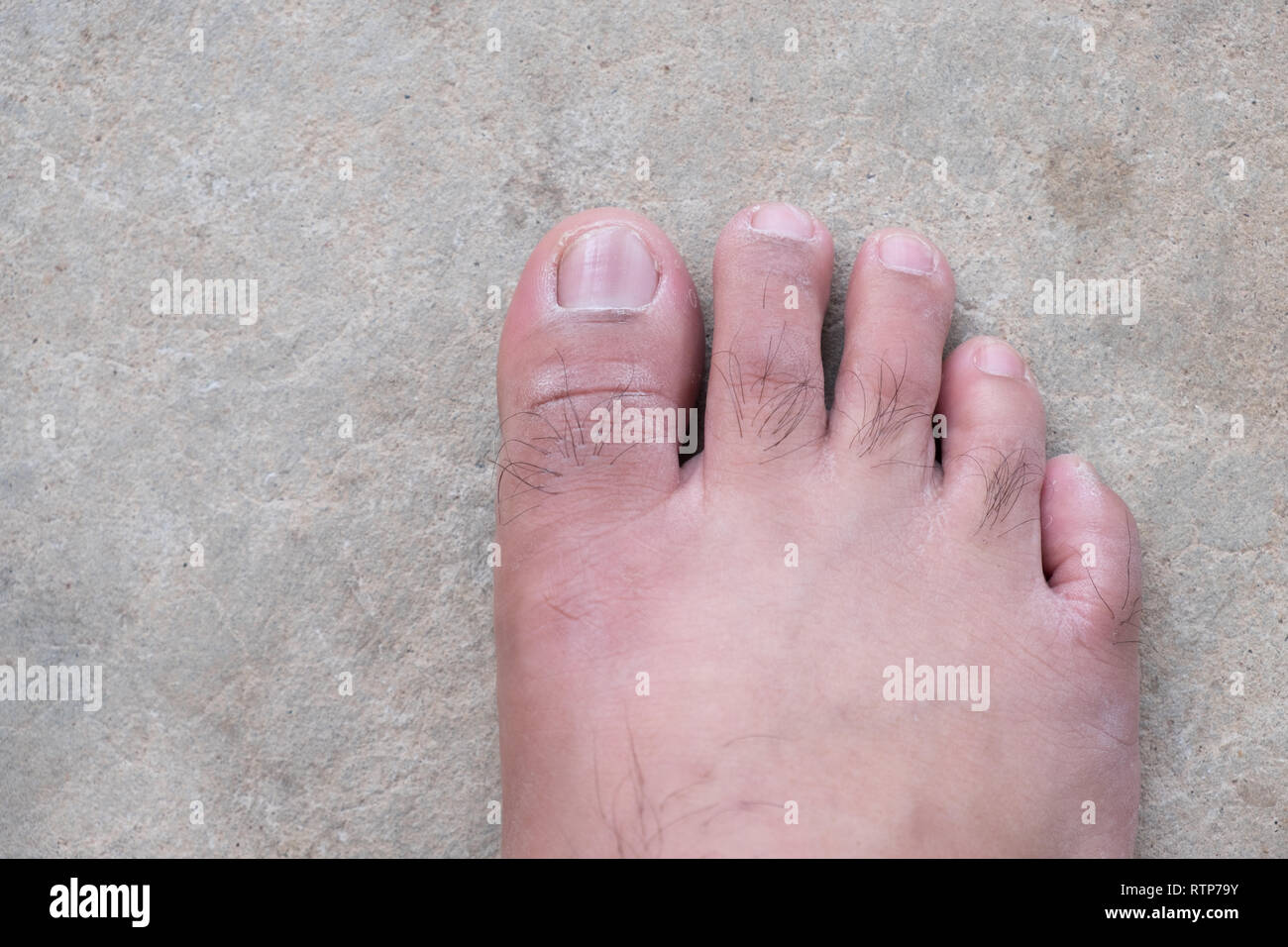 Giro in piedi o piede piatto. Salute & cura dei piedi, Closeup incrinato talloni e vene varicose. Foto Stock