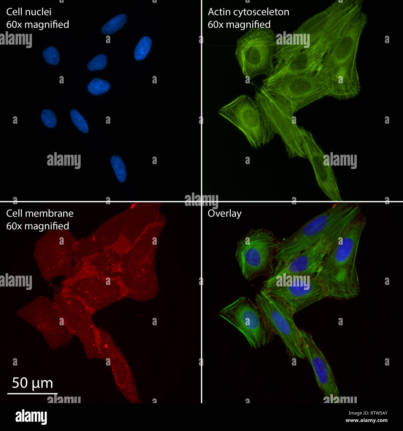 Più di osteosarcoma umano cellule colorate per epifluorescenza Foto Stock