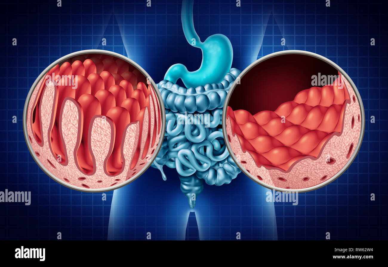 Celiachia o malattia celiaca dell'intestino anatomia concetto medico con normale villi e danneggiato intestino piccolo rivestimento come un disturbo autoimmune. Foto Stock