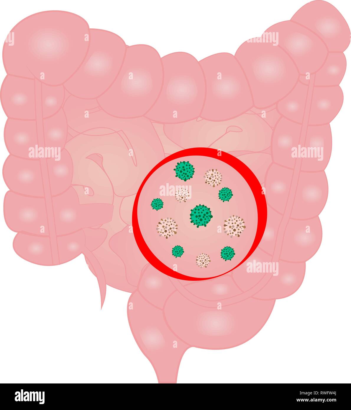 Arresto di infezione da virus nel piccolo intestino segno illustrazione vettoriale Illustrazione Vettoriale