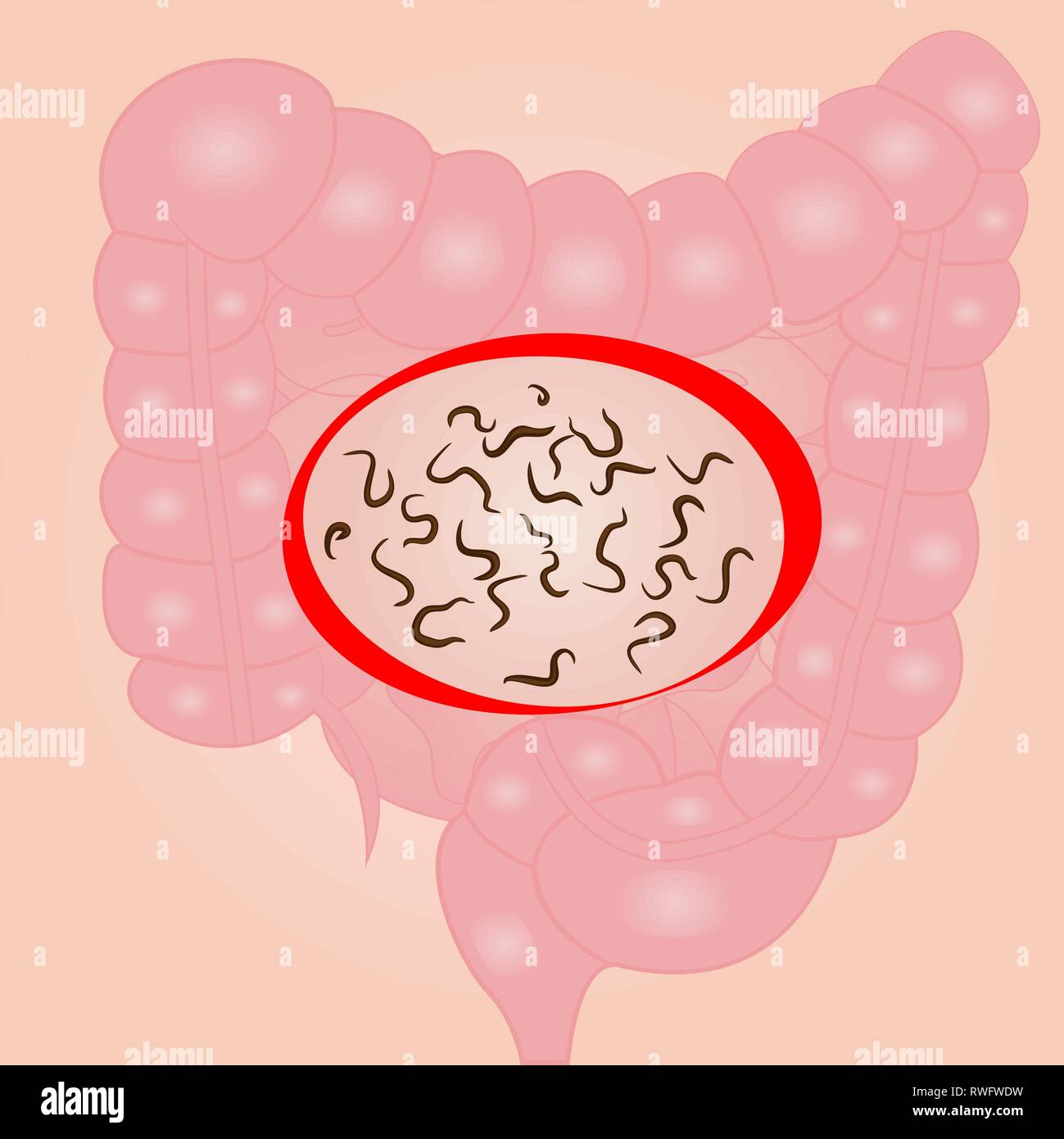 Gli elminti in un piccolo intestino illustrazione vettoriale Illustrazione Vettoriale